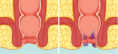 Hemorrhoids ( Piles)