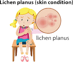 Lichen Planus icon