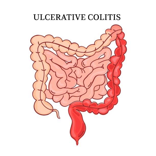 Ulcerative Colitis icon