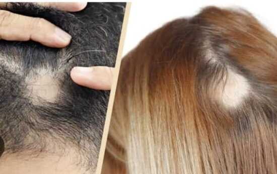 BALDNESS, FALLING OF HAIRS & ALOPECIA AREATA