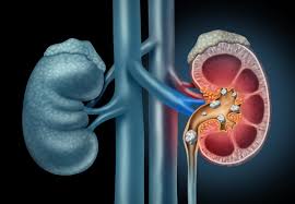 Kidney Stones And Ureteric Stones