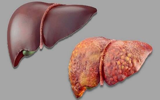HEPATITIS & LIVER PROBLEMS