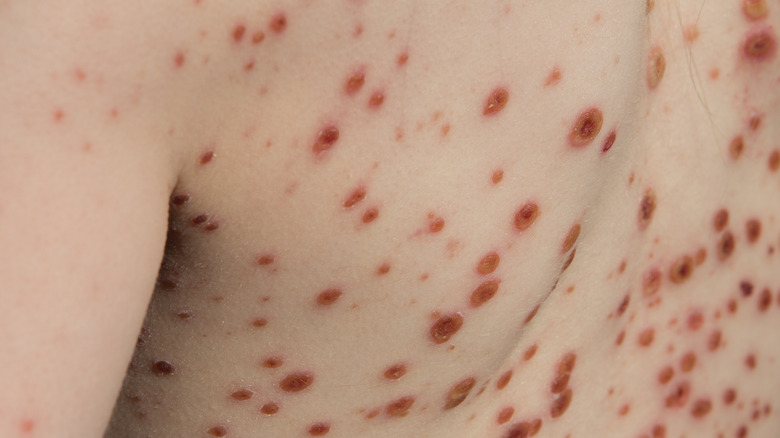 Chickenpox  icon